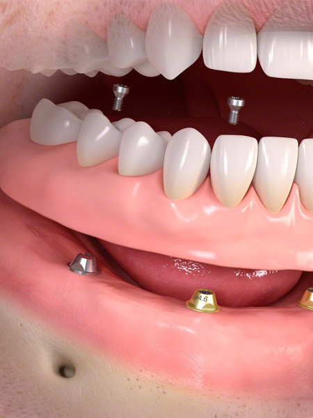 Implant Retained Dentures Dentures To You